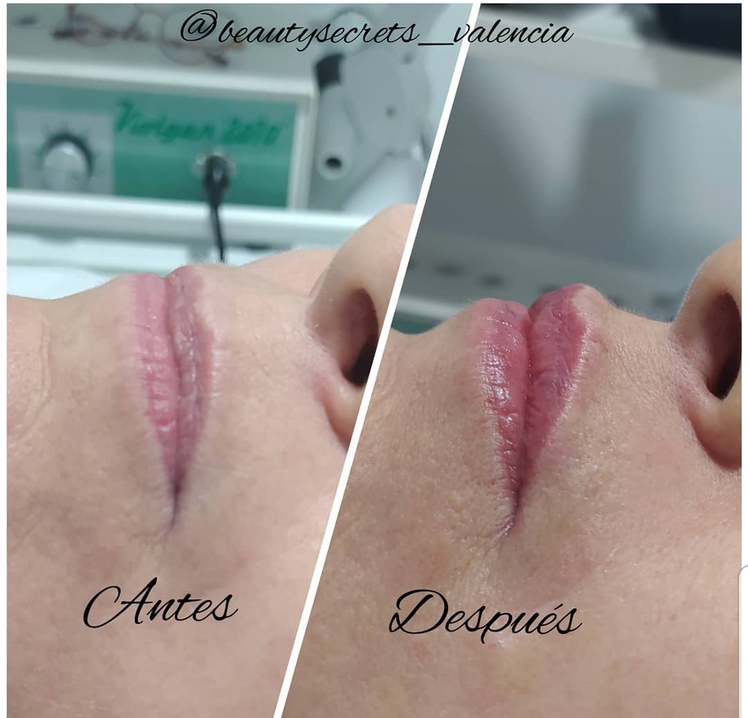 hialurón pen beauty secrets valencia