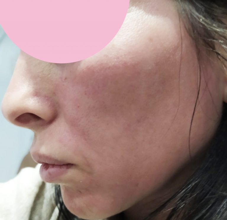 dermapen